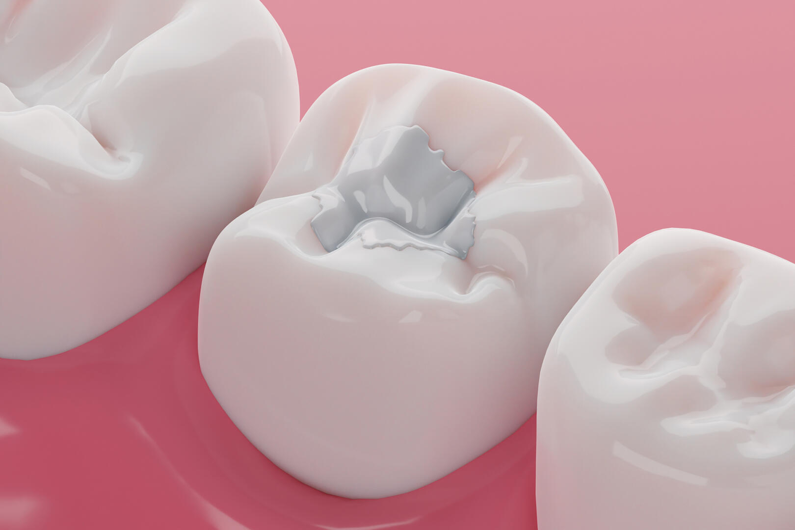 Teeth white composite filling